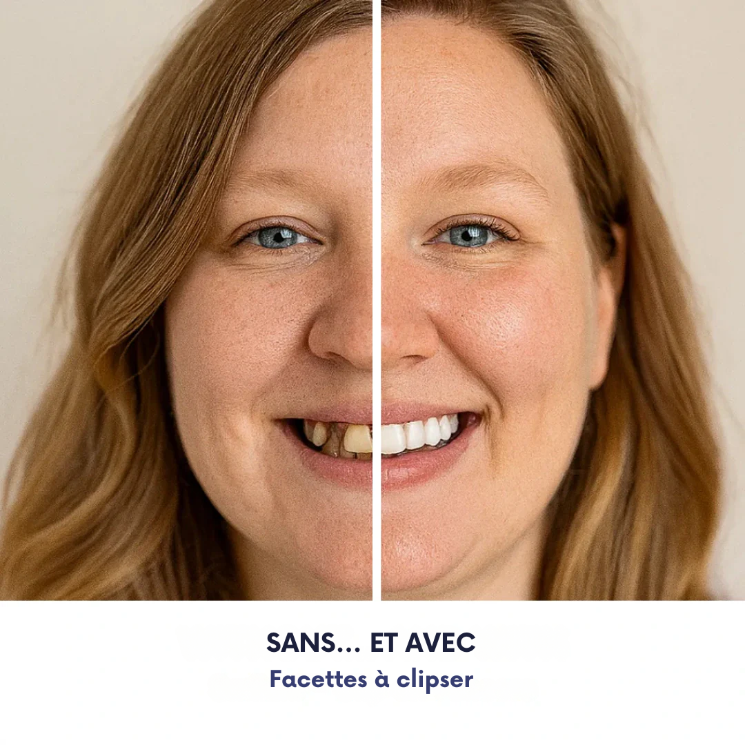 Facettes à clipser
