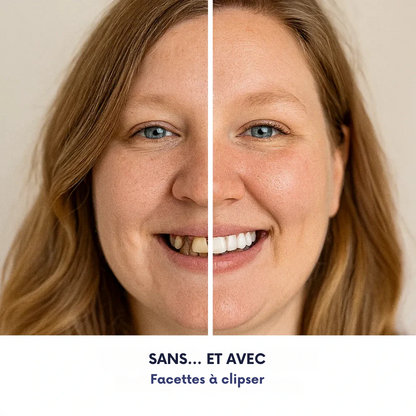 Facettes à clipser