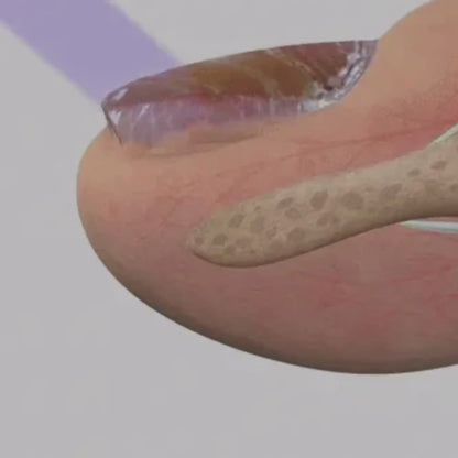 Soin Antifongique des Ongles – Action Ciblée par Lumière UV