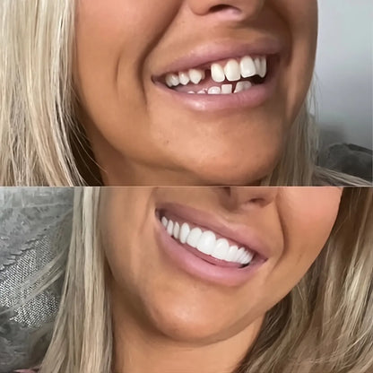 Facettes à clipser